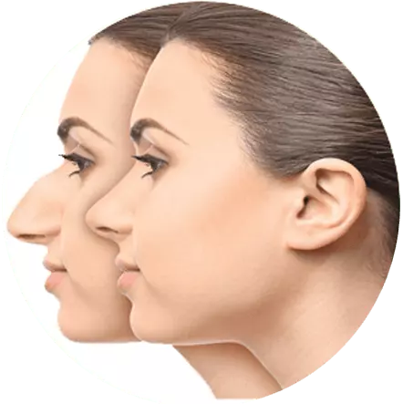 Auradale- Best Rhinoplasty or Nose Surgery Clinic in India