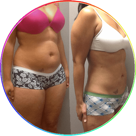 Best Cosmetic Surgery Clinic for Liposuction Treatment